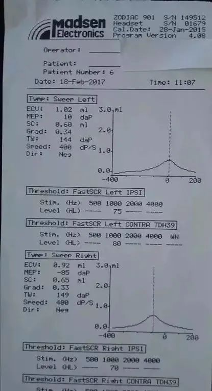 12月25日,再次做声导抗,左耳耳压10,右耳耳压-65,医生说 左耳好了