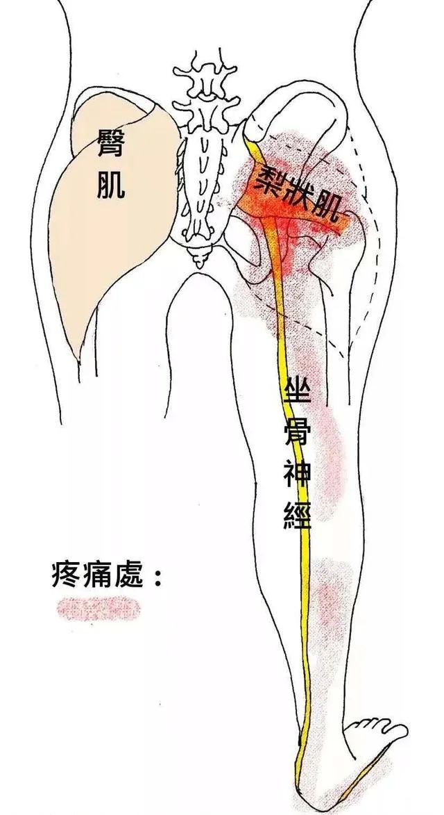 坐骨神经痛应该怎么艾灸?环跳穴配这几个穴位效果特别好,快试试!