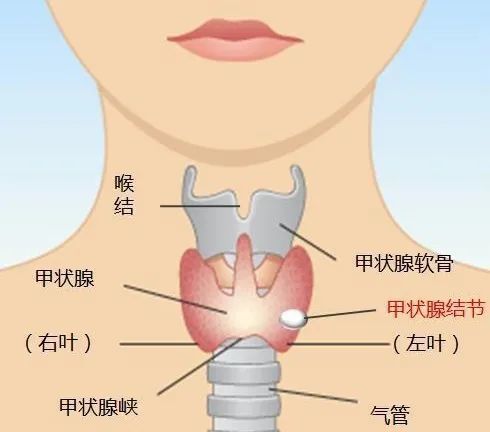 單純的甲狀腺結節艾灸選穴: 1,阿是穴(甲狀腺腫大處)